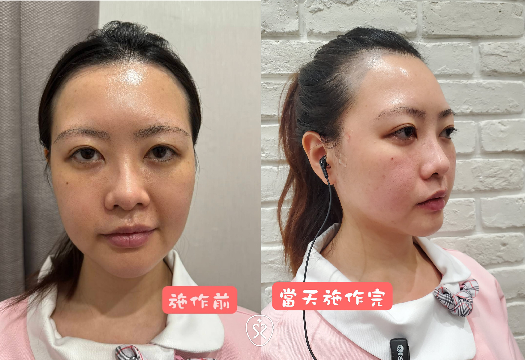 施作完的當下就有很明顯的拉提及緊實的效果